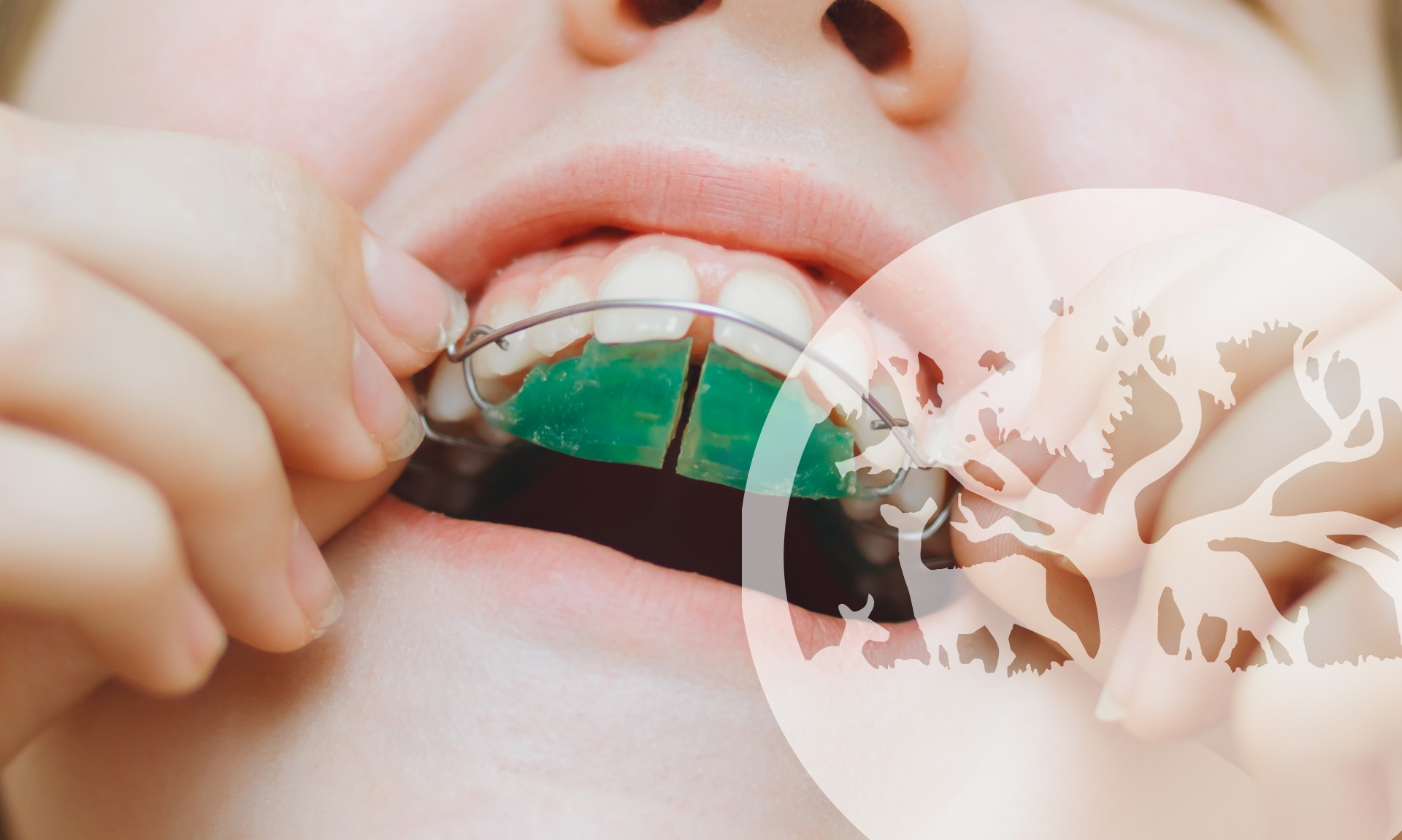 What Happens When Kids Get Bite Correction Appliances?